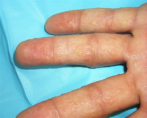 dr_Febritilova: DERMATITIS DISHIDROSIS/POMPHOLYX