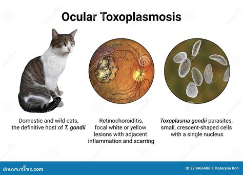 Ocular Toxoplasmosis, Retinal Scar Caused By A Toxoplasma Gondii Infection, Scientific ...