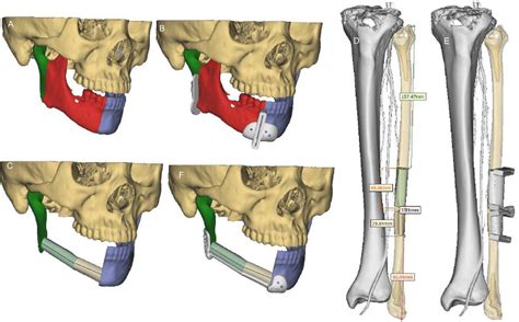 Figure 1 from Mandibular reconstruction with the vascularized fibula flap: comparison of virtual ...