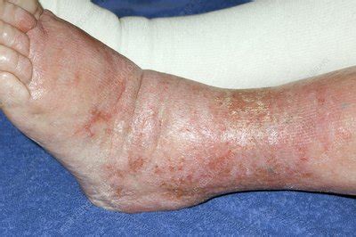 Cellulitis of the leg - Stock Image - C001/7302 - Science Photo Library