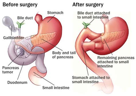 How is Pancreatic Cancer Treated? | General Surgeon Gold Coast, Weight ...