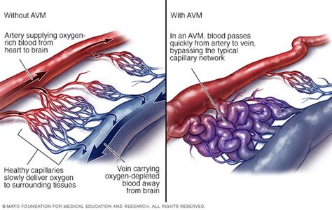 Blood vessel hardening: What it Is, Risks, Symptoms & Treatment