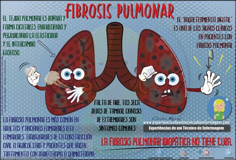 La Fibrosis Pulmonar | Enfermagem Ilustrada