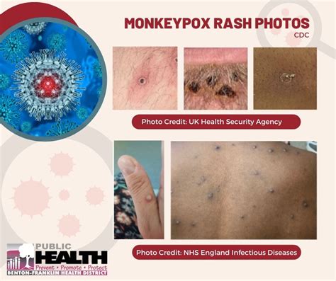 Monkeypox - Benton Franklin Health District