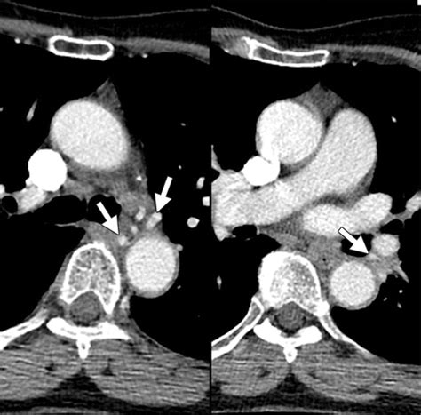 Bronchial Arteries: Anatomy, Function, Hypertrophy, and Anomalies | RadioGraphics