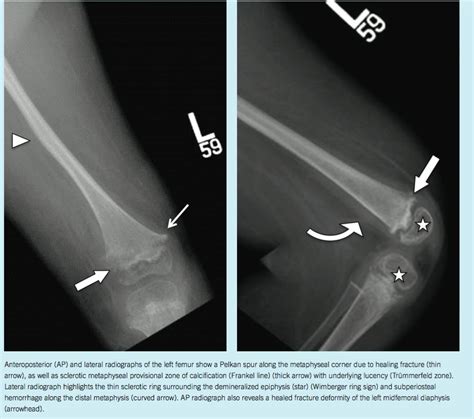 Scurvy in a 4-Year-Old Boy | Consultant360