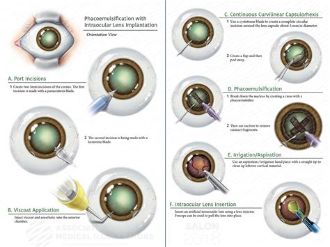 Print - Planchard Eye & Laser Center