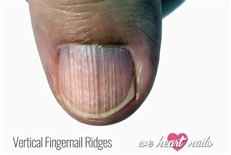 Vertical Ridges on Nails - Causes, Prevention & Treatment