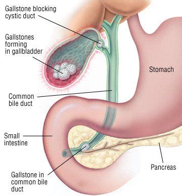 Biliary Colic Guide: Causes, Symptoms and Treatment Options