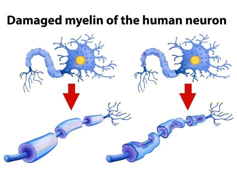 Transverse Myelitis Symptoms & Causes | Dr. Vikram