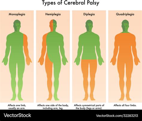 Types cerebral palsy Royalty Free Vector Image