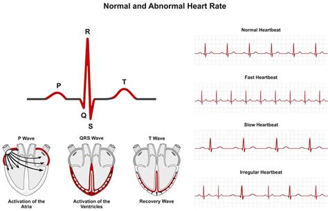 Arrhythmias meaning, causes, symptoms, diagnosis, ecg & treatment