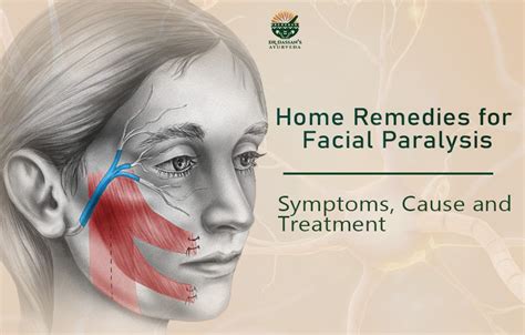 Home Remedies for Facial Paralysis | Treatment of Facial Palsy in India | by Dr. Dassan's ...