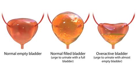 Overactive & Underactive Bladder | Urogynecologist | Pelvic Reconstruction Surgery | Transgender ...