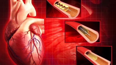 8 Surprising Facts About Cardiac Catheterization