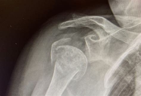 Surgery for Shoulder Fractures Not Always the Best Approach - Brigham ...