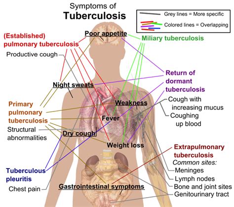 Diagnostic Challenges in Latent Tuberculosis Infection: A Brief Review ...