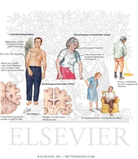 Other Tauopathies. Corticobasal Degeneration and Frontotemporal Dementia