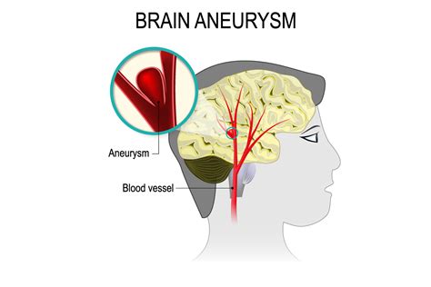 Unruptured Brain Aneurysm Treatment : The goal of treatment for both ruptured and unruptured ...