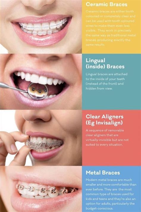 Pin by American Braces & Smile Center on Braces Types | Straighten ...