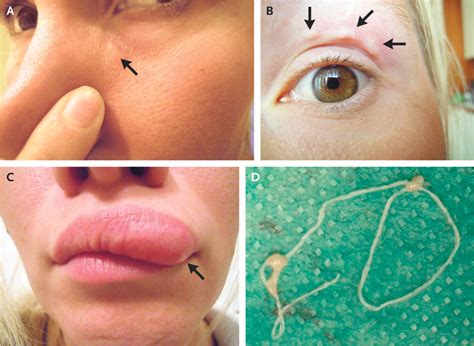 Lump On Woman's Face Turns Out To Be A Parasite Crawling Under Her Skin - MEDizzy Journal