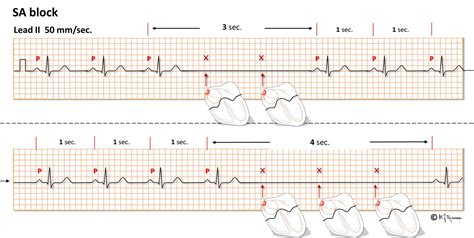 Sinus arrest and sino-atrial block (SA block)