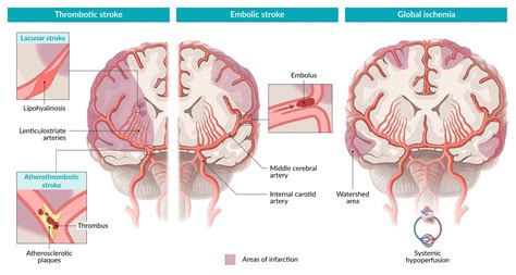 Lacunar Stroke Syndromes