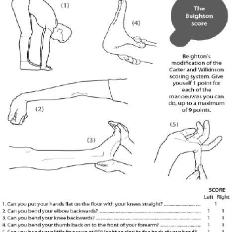 Ehlers-Danlos Syndrome - My Diagnosis - Healthwatch Central Bedfordshire