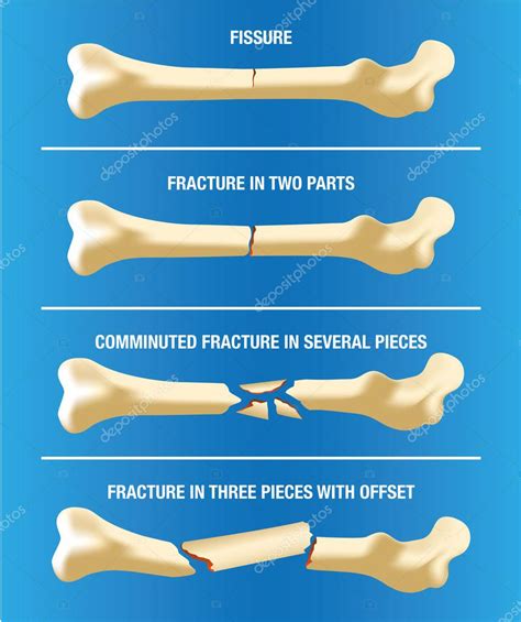 Anatomy various skeletal bone fractures. Ideal for medical and institutional materials — Stock ...