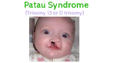 Trisomy 13 (Patau Syndrome): Symptoms, Causes Outlook, 58% OFF