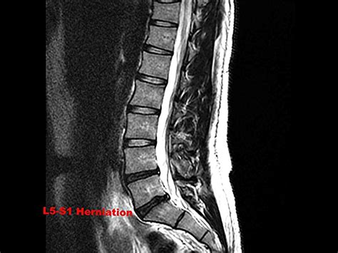 Mesquite Herniated Disc Doctor | Garland Disc Herniation Chiropractor