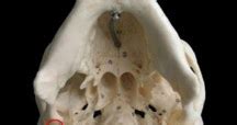 Petrotympanic fissure - Pictures, Skull, Chorda tympani, Petrosquamous fissure - Health Care ...