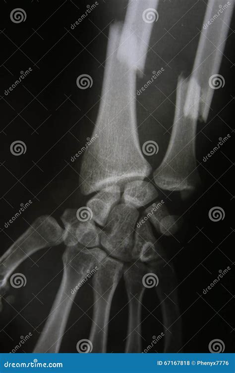 X-ray Image of Broken Forearm, AP and Lateral View Show Fracture Stock Photo - Image of break ...