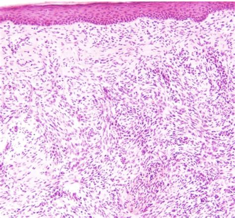 [Figure, Dermatofibrosarcoma Protuberans Histology. Dermatofibrosarcoma protuberans (DFSP ...