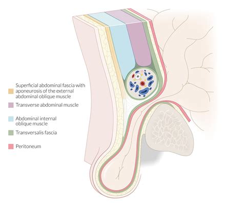 Femoral Ring Boundaries