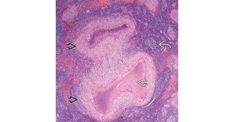 Granulomatous inflammation - New