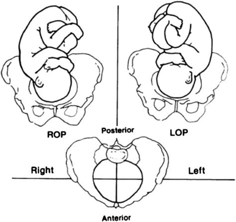 Right Sacrum Anterior Fetal Position