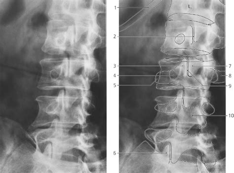 Spine | Radiology Key