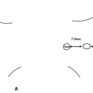 Port placement according to the surgical approach (laparoscopic (A),... | Download Scientific ...