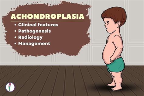 Achondroplasia: Medicine Notes