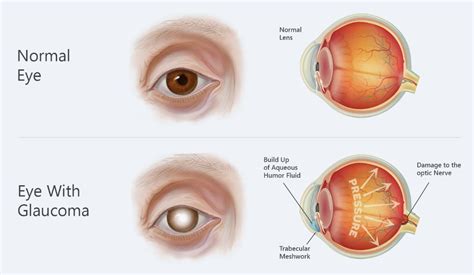 Prevalent Eye Diseases: A cause for better eye care