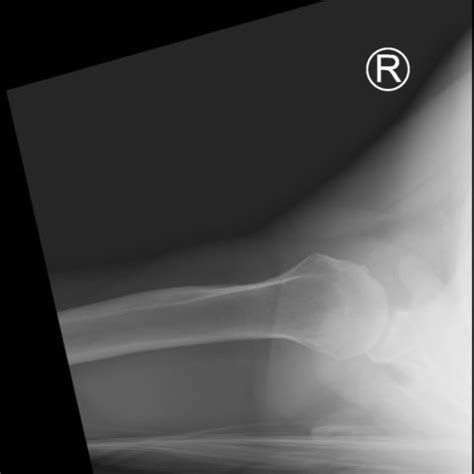 Shoulder dislocation: Lightbulb sign, Chest X-ray and Post-Reduction ...