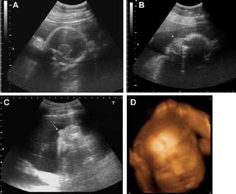 Prenatal ultrasound at 24 weeks of gestation shows (A) alobar ...