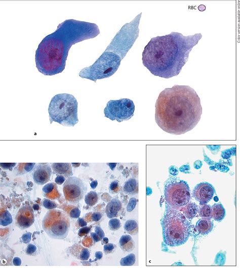 Figure 2 from High-Grade Urothelial Carcinoma on Urine Cytology ...