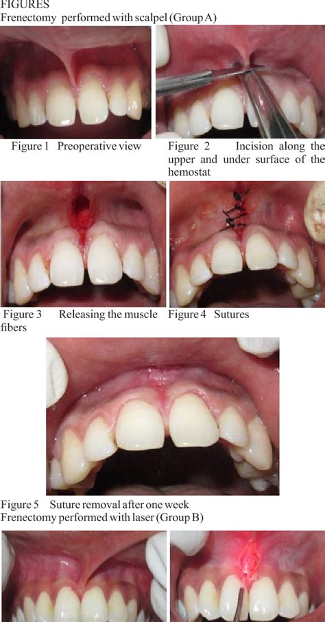 Figure 1 from COMPARATIVE EVALUATION OF FRENECTOMY PROCEDURES PERFORMED WITH SCALPEL, LASER AND ...