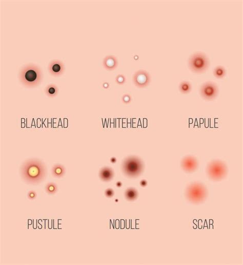 What is a Pustule Skin Lesion? - 4Nids