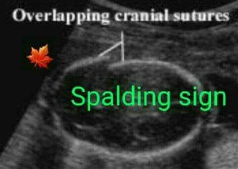 2 Skull signs to identify Intrauterine Fetal Demise 🍁SPALDING Sign ...