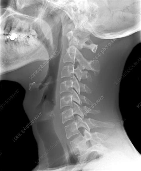 Normal neck, X-ray - Stock Image - C010/3497 - Science Photo Library