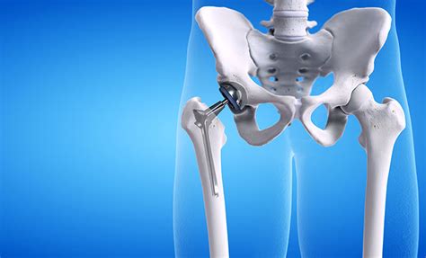 What is a Total Hip Replacement? - Cary Orthopaedics