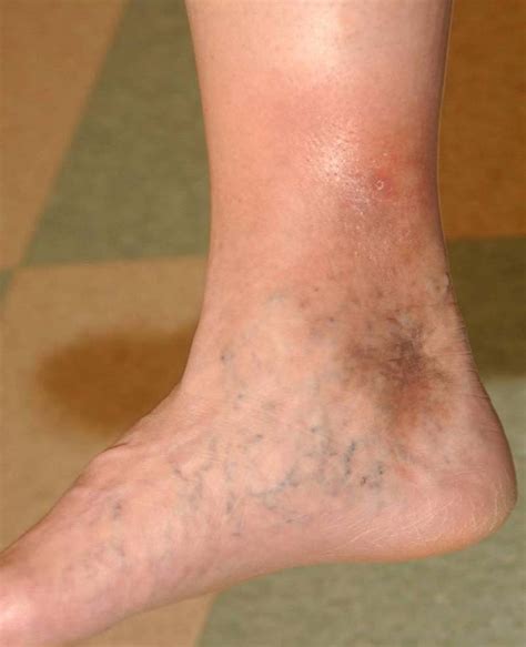 Lipodermatosclerosis (hypodermitis sclerodermiformis, sclerosing panniculitis, pseudoscleroderma ...